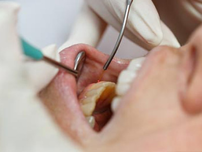 The image depicts a dental professional performing a procedure on a patient s mouth using a dental drill and other instruments, with a focus on precision and care.