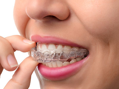 The image shows a person with a clear aligner, possibly a part of an orthodontic treatment, holding it up to their mouth while examining it closely.