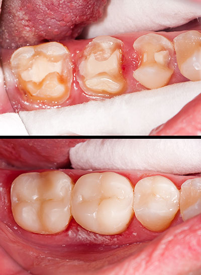 The image shows a close-up view of a person s teeth with visible decay and damage, accompanied by a separate image of an open mouth revealing the same teeth from a different angle.