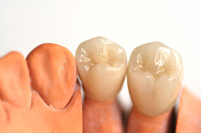 The image depicts three artificial teeth with visible dental implants, displayed against a white background.