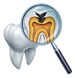 The image shows a magnified view of a tooth with an open crown through which a dental probe can be seen, revealing a cavity with a visible pulp chamber at the center, surrounded by yellowish-brown stained dentin and pinkish gum tissue.