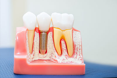 The image shows a dental model with multiple teeth, some of which have been modified with dental implants or crowns, displayed on a pink plastic base against a blue background.