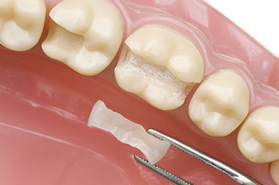 The image shows a close-up of a dental implant being placed into a prepared tooth socket within an open mouth, with visible dental tools and a piece of bone graft material.