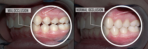 The image shows two close-up photographs of a person s mouth with teeth, taken from different angles.