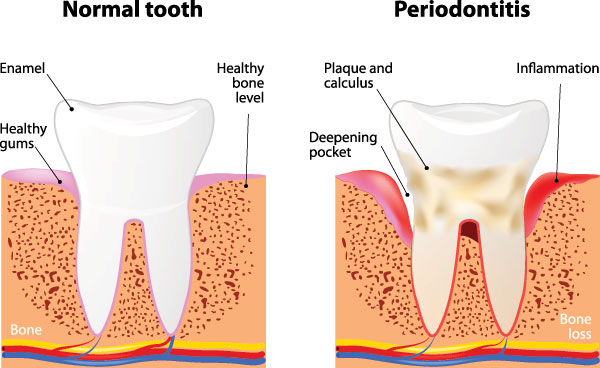 The image presents a detailed medical illustration showing the process of tooth decay, from the initial formation of plaque and tartar to the advanced stages of cavity formation and gum disease, with annotations explaining the pathology and the effects of poor oral hygiene on teeth and gums.