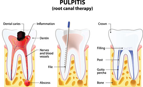 The image depicts a detailed illustration of dental pulpitis with labeled parts, including the tooth crown, dentin, nerves, and inflammation, highlighting the process of infection within the pulp chamber.