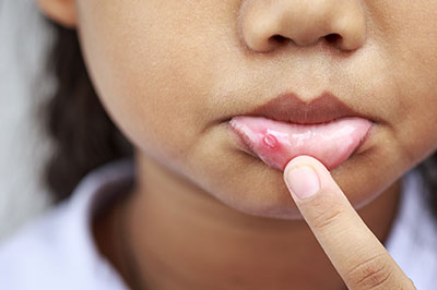 The image shows a close-up of a person s face with a focus on their lips, which appear swollen or inflamed, possibly indicating an allergic reaction or irritation.