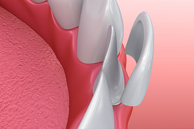 The image shows a close-up view of a dental implant with multiple screws or bolts visible on its surface, set against a pink background that resembles gum tissue.