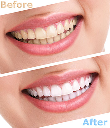 The image displays a before-and-after comparison of teeth whitening, with two photos of a person s smile showing a noticeable difference in tooth color after treatment.