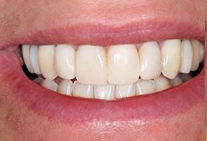 The image shows a close-up of a person s teeth with a bright smile, emphasizing oral hygiene and dental health.