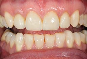 The image shows a close-up of a person s teeth with visible staining, particularly on the front teeth, which are yellowed.