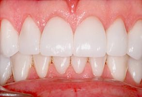 The image shows a close-up view of a person s teeth with a focus on the front teeth, which appear to be in the process of being whitened.