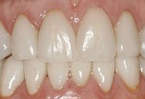 The image shows a close-up view of a person s mouth with visible teeth, including some dental work such as a bridge or implant, and gums that appear healthy.
