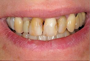 The image displays a close-up view of a person s teeth with yellow stains, showcasing a dental condition known as tooth discoloration or staining.