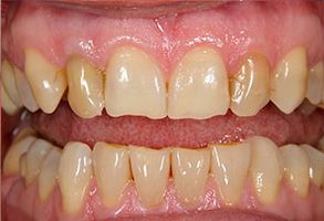 The image displays a close-up view of a person s teeth with visible signs of dental decay and discoloration, showcasing a need for dental care and treatment.
