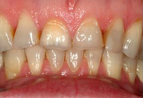 The image shows a close-up view of a person s teeth, which appear discolored with yellow stains and some tooth decay, suggesting a need for dental care or treatment.